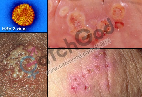 webmd_rm_photo_of_herpes_simplex_virus_type_2.jpg